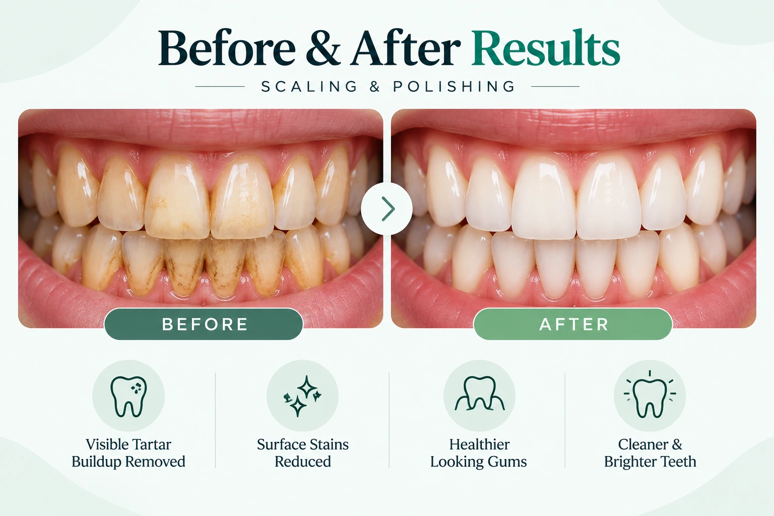 Before and after scaling and polishing results showing tartar and surface stain removal