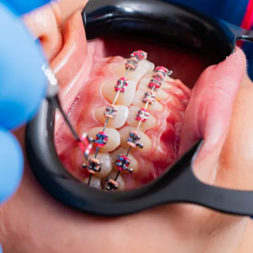 Orthodontist adjusting braces for teeth alignment in Islamabad