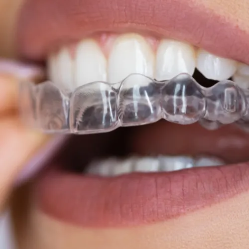 Clear aligner being fitted over teeth for orthodontic treatment