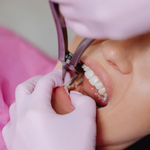 Simple tooth extraction procedure at Smile Center Islamabad