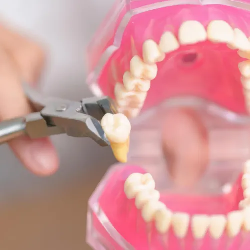Dental model demonstrating tooth extraction procedure