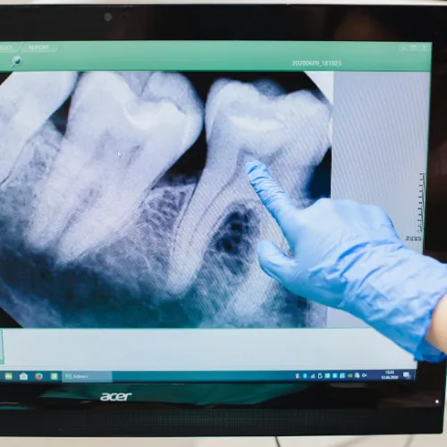 Dental X-ray for tooth extraction assessment in Islamabad