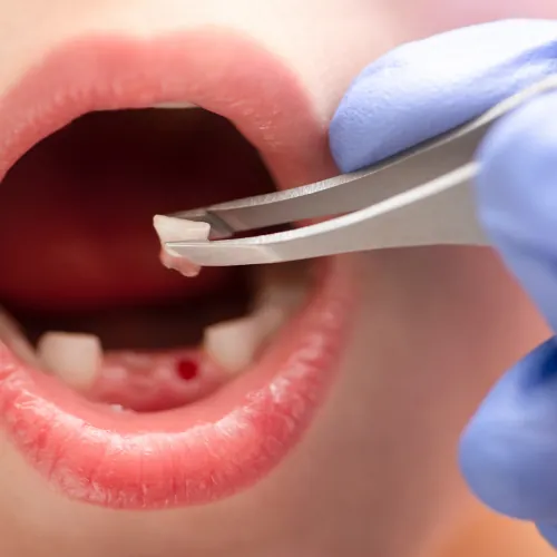 Surgical tooth extraction performed by a dentist in Islamabad