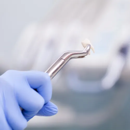 Extracted tooth after dental extraction procedure