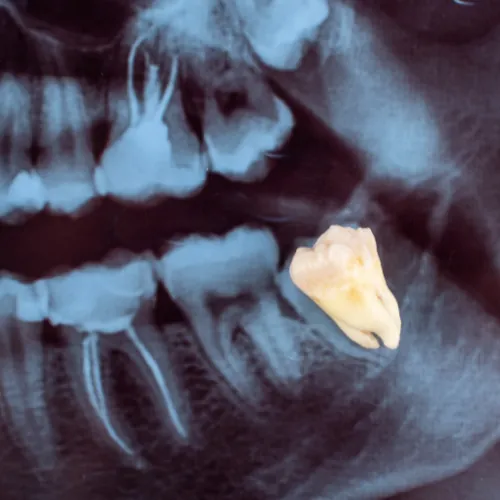 Impacted wisdom tooth removal treatment in Islamabad