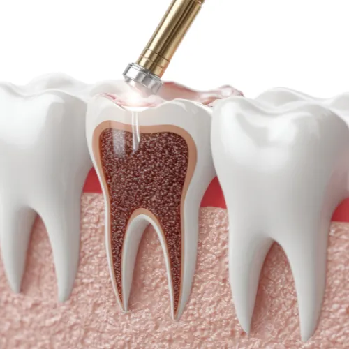 Dental cavity restoration with filling treatment