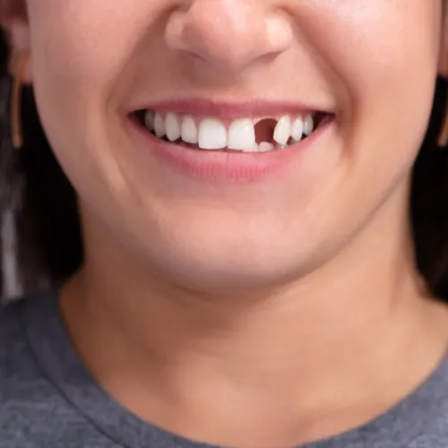 Damaged front tooth requiring restorative dental treatment