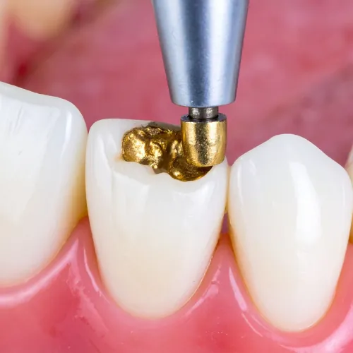 Dental filling restoration and polishing treatment in Islamabad