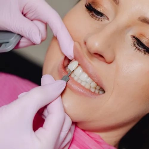 Tooth shade matching for cosmetic dental filling in Islamabad