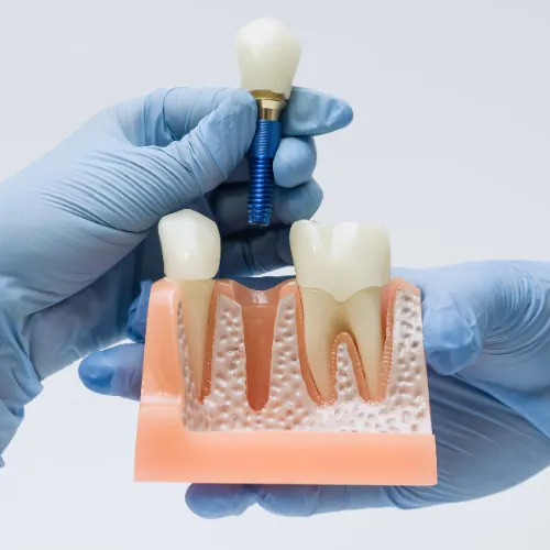 Dental implant consultation and treatment planning in Islamabad