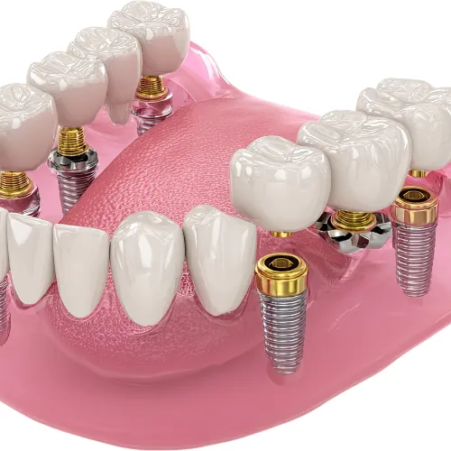 Multiple dental implants for replacing missing teeth