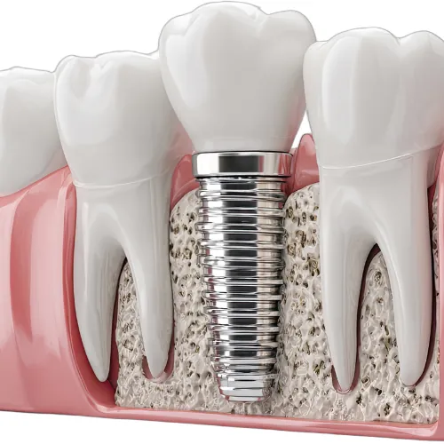 Dental implant replacing a missing tooth at Smile Center Islamabad