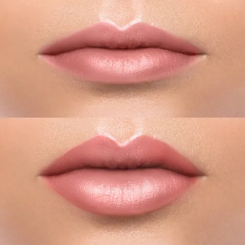 Before and after lip filler treatment for natural lip enhancement