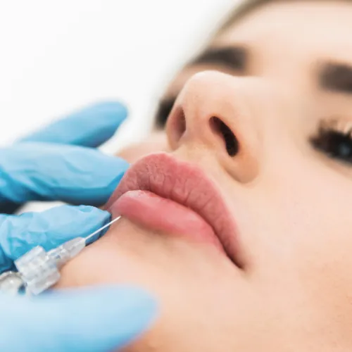 Hyaluronic acid lip filler injection for lip enhancement