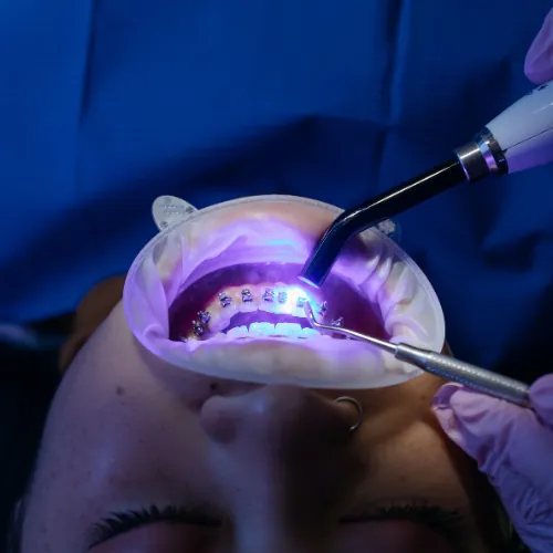 Orthodontic braces bonding procedure at Smile Center Islamabad