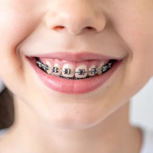 Metal braces for correcting crooked teeth in Islamabad