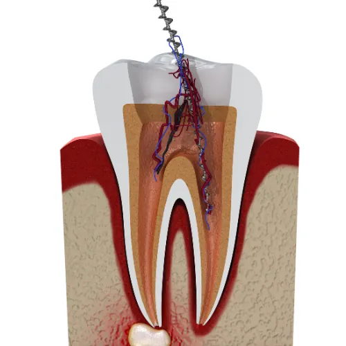 3D illustration showing root canal cleaning inside an infected tooth
