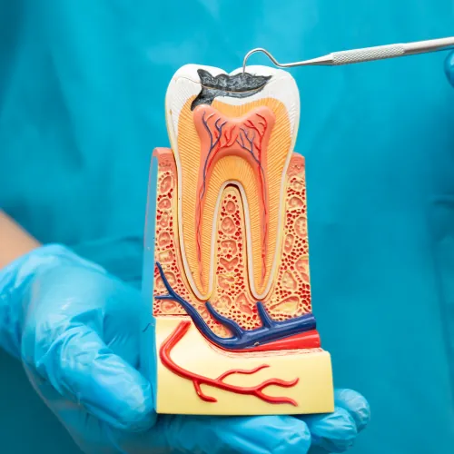 Tooth anatomy model showing deep decay and inner pulp infection for root canal treatment