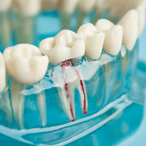 Dental model showing restored teeth after root canal treatment