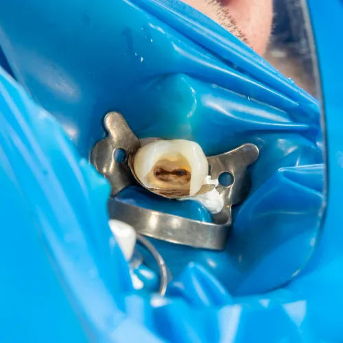 Tooth isolated with rubber dam during root canal treatment procedure