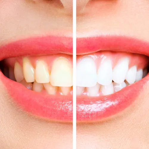 Before and after teeth whitening results showing brighter teeth