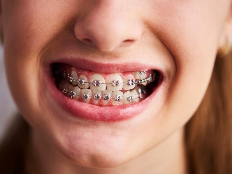 Dental Implants Smile Center Islamabad 2